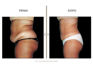 Dott. Alessandro Maria Caboni Addominoplastica