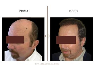 Trapianto capelli prima e dopo - 878792