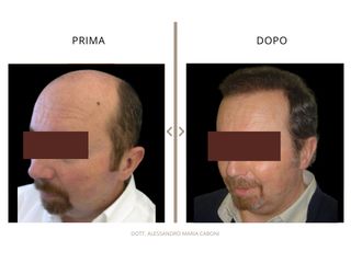 Dott. Alessandro Maria Caboni trapianto capelli