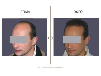 Trapianto capelli prima e dopo - 878793