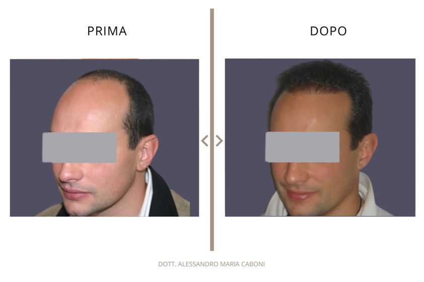 Trapianto capelli prima e dopo - 878793
