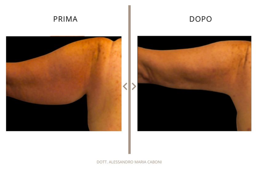 Liposuzione prima e dopo - 878794