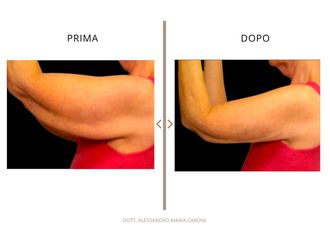 Liposuzione prima e dopo - 878795