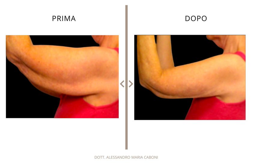 Liposuzione prima e dopo - 878795