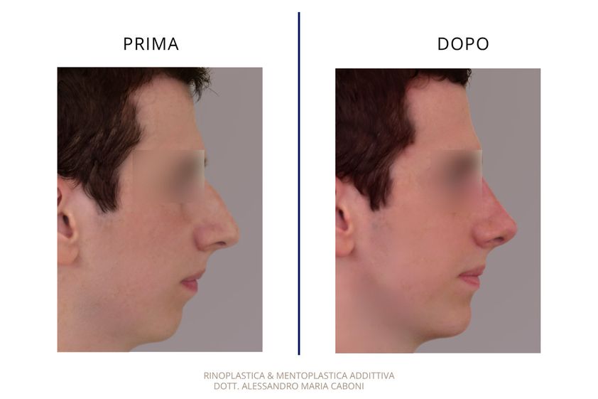 Rinoplastica prima e dopo - 881465