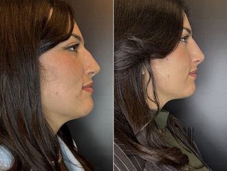 Rinofiller prima e dopo - 877121