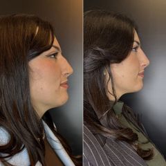 PPM Medical Rinofiller