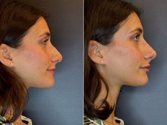 Rinofiller prima e dopo - 877156