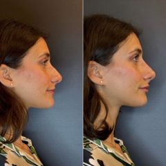 PPM Medical Rinofiller