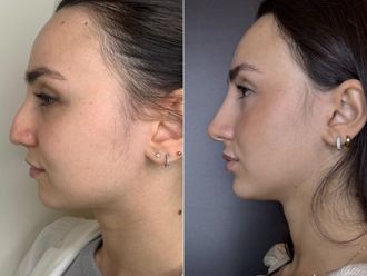 Rinofiller prima e dopo - 877157