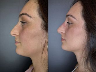 Rinofiller prima e dopo - 877158