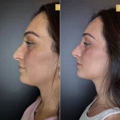 PPM Medical Rinofiller