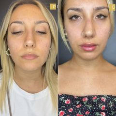 PPM Medical Filler labbra