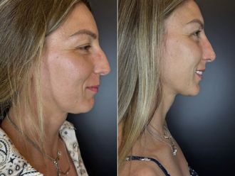 Rinofiller prima e dopo - 877160