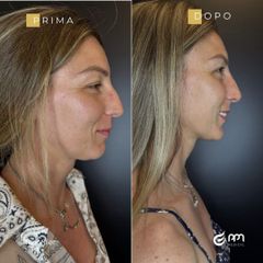 PPM Medical Rinofiller