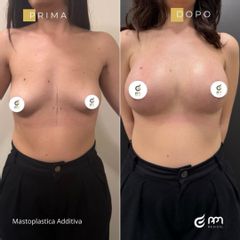 PPM Medical Mastoplastica additiva