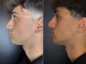 Rinofiller prima e dopo - 877162