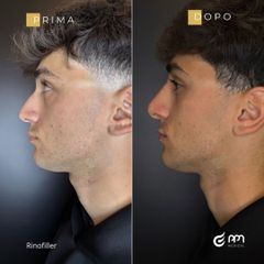 PPM Medical Rinofiller