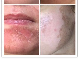 Peeling prima e dopo
