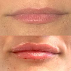 Lip filler con acido ialuronico - Dott.ssa Elena Ricci Barbini