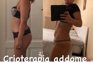 Criolipolisi - Dott.ssa Elena Ricci Barbini