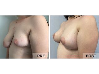 Asimmetria mammaria prima dopo