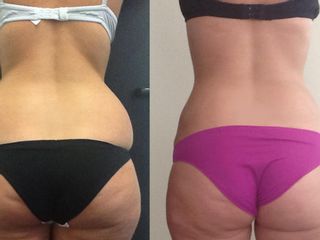 lipoaspirazione prima dopo