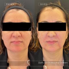 Full face: zigomi, mandibola e rughe - Dott.ssa Giuseppina Dodaro