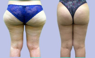 Liposuzione associata alla liposcultura