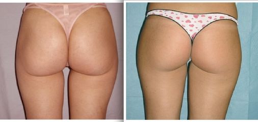 Liposcultura pre e post