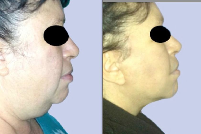 Liposcultura prima e dopo - 747495