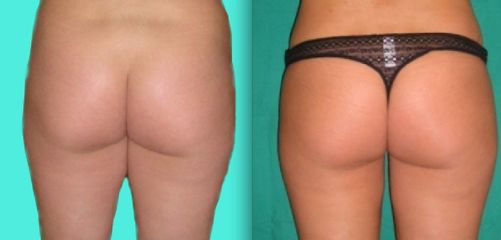Liposcultura glutei