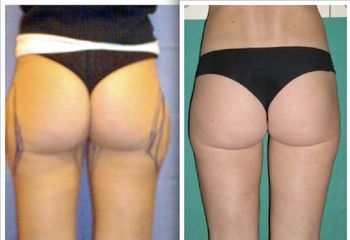 Liposcultura fianchi prima e dopo