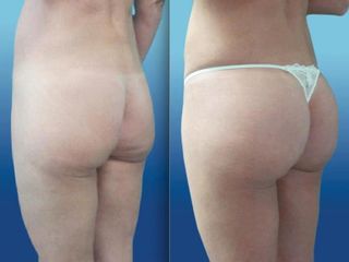 Gluteoplastica additiva intramuscolare