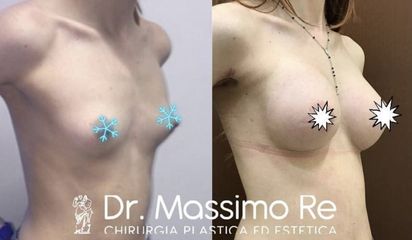 Mastoplastica additiva - Dott. Re Massimo