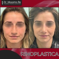 Rinoplastica - Dott. Massimo Re