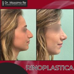 Rinoplastica - Dott. Massimo Re