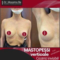 Mastoplastica additiva - Dott. Massimo Re