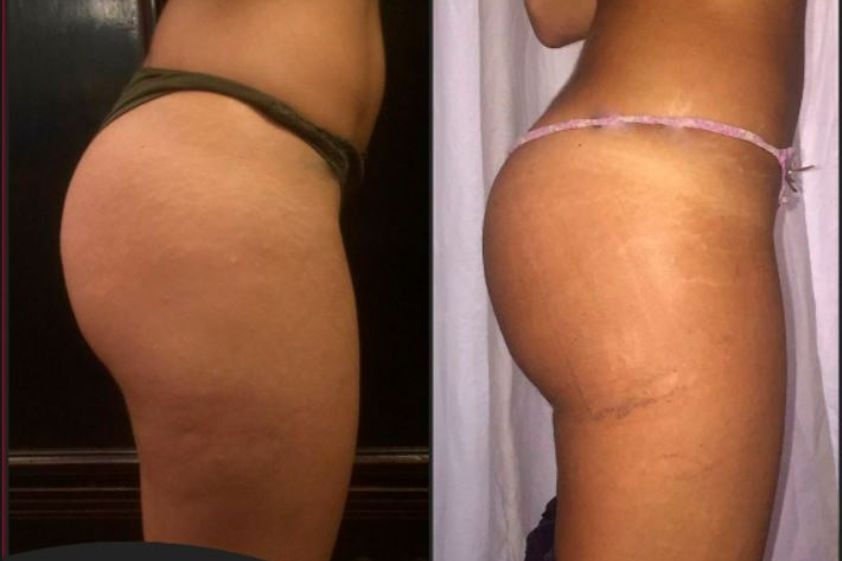 Gluteoplastica prima e dopo - 851787