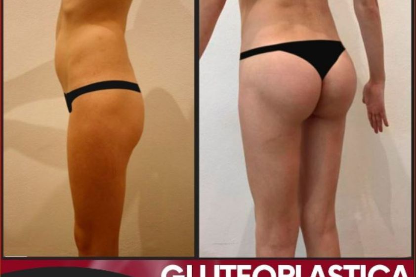 Gluteoplastica prima e dopo - 851788