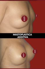 Mastoplastica additiva - Dott. Massimo Re