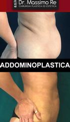 Addominoplastica - Dott. Massimo Re