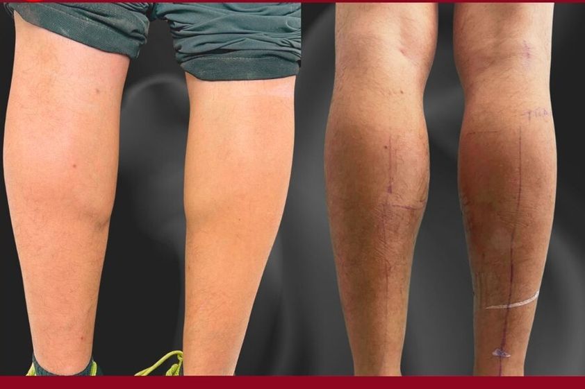 Liposcultura prima e dopo - 873061