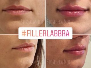 Filler labbra - Biosphera Med