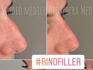 Rinofiller - Biosphera Med