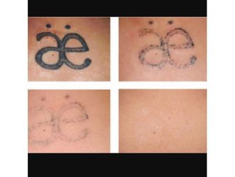 Rimozione tatuaggi-789315