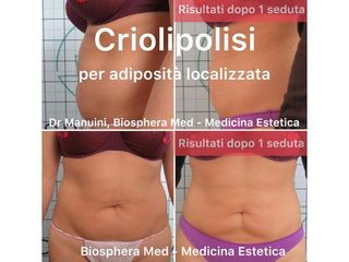 Criolipolisi - Studio medico BiospheraMed