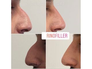 Rinofiller - Studio medico BiospheraMed