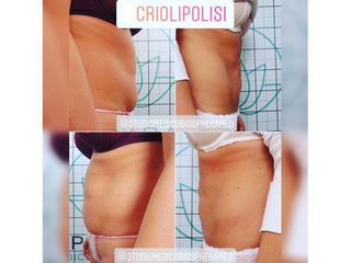 Criolipolisi - Studio medico BiospheraMed