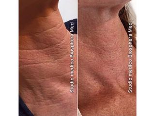 Lifting collo - Studio medico BiospheraMed